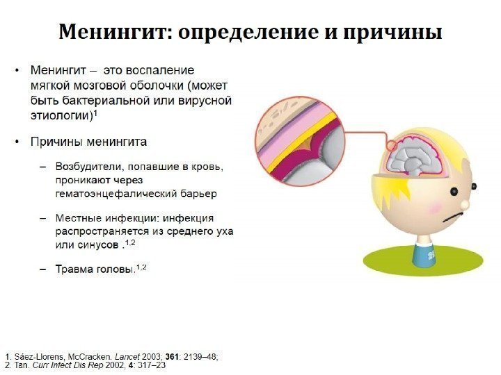 Менингит: определение и причины 